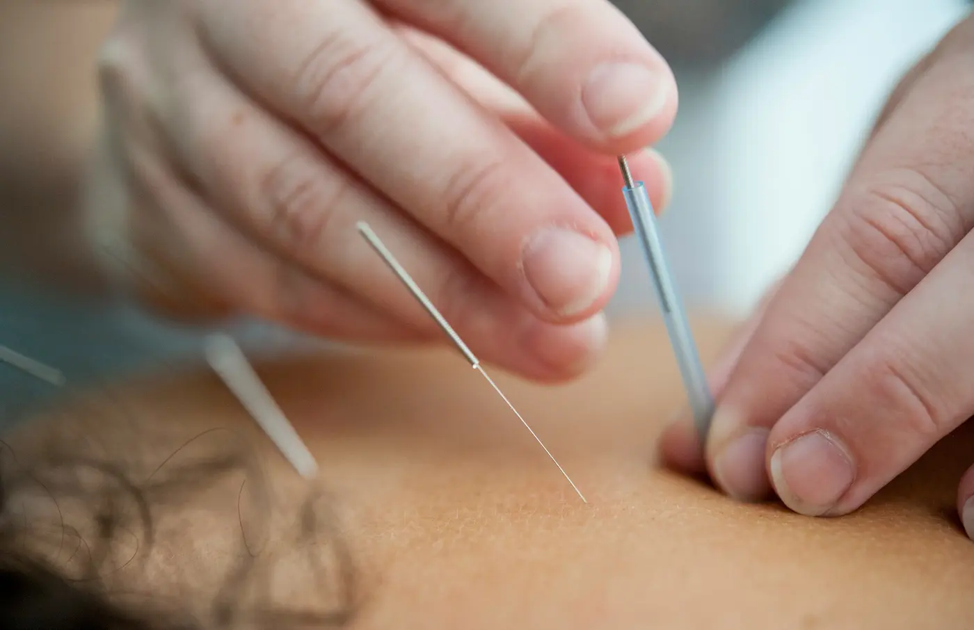 Is Acupuncture the Answer to Chronic Pain?