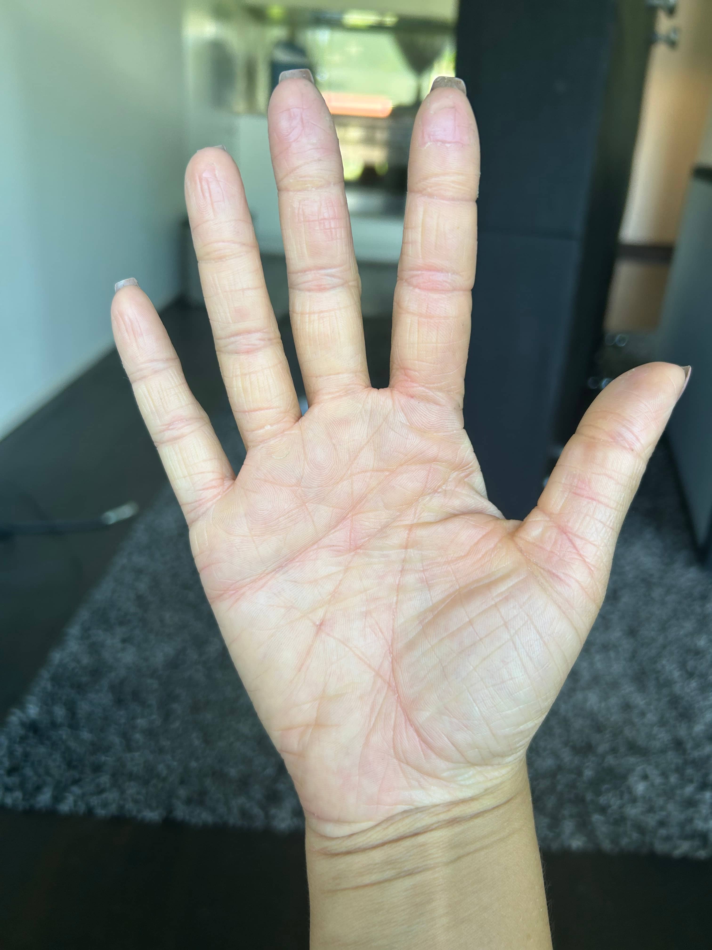 After Eczema